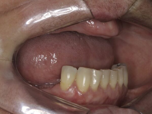 Síndrome de Kelly: identificação e tratamento